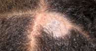 کرم حلقوی پوست سر (Tinea Capitis)