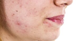 چه چیزی باعث افزایش تستوسترون در زنان می شود؟