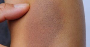 رنگ های کبودی به چه معناست؟