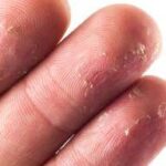 چه چیزی باعث پوسته شدن پوست نوک انگشتان می شود؟