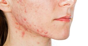 چه چیزی باعث ایجاد آکنه در خط فک می شود؟