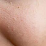 چگونه می توانم از دست میلیا خلاص شوم؟