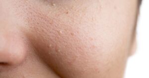 چگونه می توانم از دست میلیا خلاص شوم؟