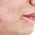 چه چیزی باعث افزایش تستوسترون در زنان می شود؟