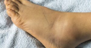 Why are my feet swollen?