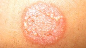 کرم حلقوی بدن (Tinea Corporis)