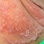 چه چیزی باعث جوش زیر بغل می شود؟