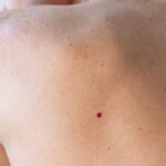 چگونه از شر آنژیوم گیلاس خلاص شویم