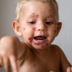 Impetigo: Everything You Need to Know