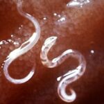 Intestinal worms in humans and their symptoms