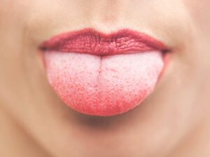 برجستگی دروغ (پاپیلیت گذرا زبانی)healthline.comhttps://www.healthline.com › سلامتی