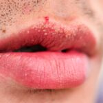 نقاط فوردایس: شناسایی، درمان و Morehealthline.comhttps://www.healthline.com › سلامت