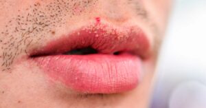نقاط فوردایس: شناسایی، درمان و Morehealthline.comhttps://www.healthline.com › سلامت