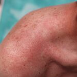 بثورات حرارتی خاردار: درمان ها، علل، و Morehealthline.comhttps://www.healthline.com › سلامتی
