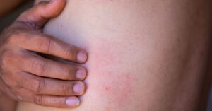 بیماری سلیاک و زونا: آیا به هم مرتبط هستند؟healthline.comhttps://www.healthline.com › سلامتی