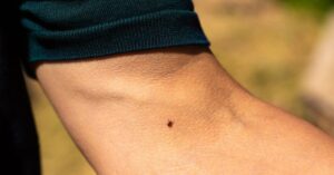 گزش کنه: علائم، درمان، تصاویر، و پیشگیریhealthline.comhttps://www.healthline.com › سلامتی