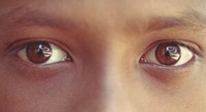 Eyelid Dermatitis: Treatments, Symptoms, Causes, and Morehealthline.comhttps://www.healthline.com › health
