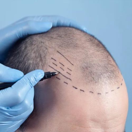 طراحی خط رویش کاشت مو