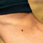 گزش کنه: علائم، درمان، تصاویر، و پیشگیریhealthline.comhttps://www.healthline.com › سلامتی