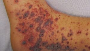پتشی: علل و درمان هاmedicalnewstoday.comhttps://www.medicalnewstoday.com › ...