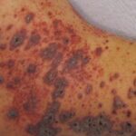 پتشی: علل و درمان هاmedicalnewstoday.comhttps://www.medicalnewstoday.com › ...