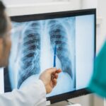 چگونه رادیوگرافی قفسه سینه می تواند به تشخیص سل کمک کند؟healthline.comhttps://www.healthline.com › سلامتی