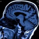 تومورهای مغزی به رژیم غذایی و پرتودرمانی پاسخ می دهند