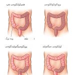 کولکتومی (جراحی برداشتن روده بزرگ): چیست و انواع آن