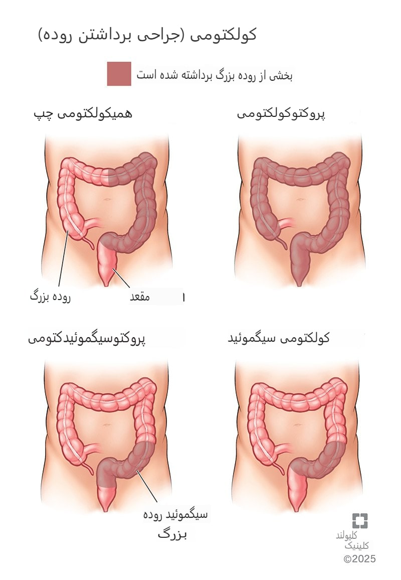 کولکتومی (جراحی برداشتن روده بزرگ): چیست و انواع آن