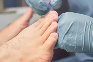 آنچه باید درباره اونیکولیزیس (جداشدگی ناخن) بدانید