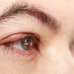 چگونه از شر گل مژه خلاص شویم: گزینه‌های مراقبت از خود و درمان