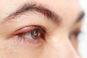 چگونه از شر گل مژه خلاص شویم: گزینه‌های مراقبت از خود و درمان