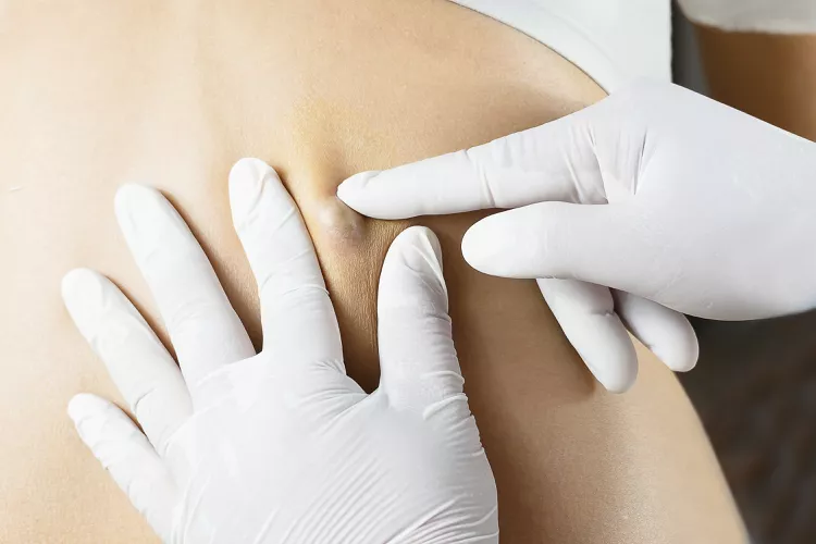 چرا کیستهای چربی تشکیل میشوند و اگر یکی از آنها ترکید چه باید کرد؟ rdiet.ir