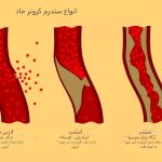 انفارکتوس میوکارد بدون قطعه قطعه شدن قطعه ST چیست؟