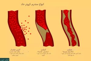 انفارکتوس میوکارد بدون قطعه قطعه شدن قطعه ST چیست؟