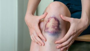 چگونه مایع مفصلی را افزایش دهیم و از سلامت مفاصل محافظت کنیم؟