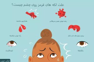 چه چیزی باعث ایجاد لکه قرمز روی چشم شما می‌شود؟ rdiet.ir