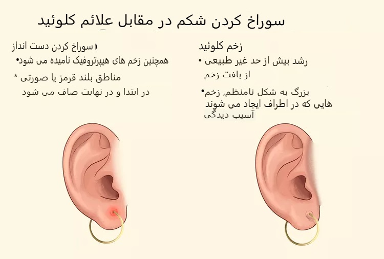 تفاوت بین برآمدگی ناشی از پیرسینگ و کلوئید چیست؟ rdiet.ir
