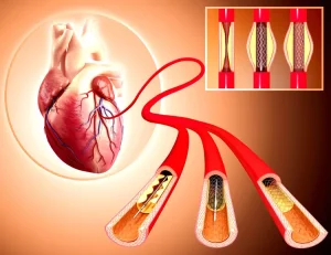نرخ بقا پس از قرار دادن استنت قلبی