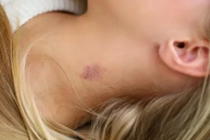 8 راه ساده برای از بین بردن سریع جای بوسه (Hickey)