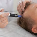 آیا میکرونیدلینگ پوست سر واقعاً می‌تواند به رشد مجدد مو کمک کند؟