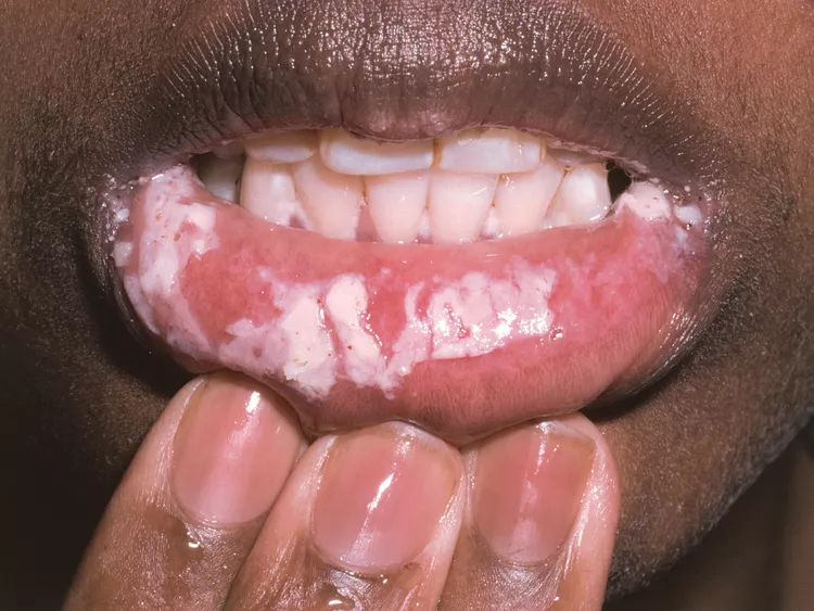 کاندیدیازیس دهانی مرتبط با HIV بازتولید با اجازه © DermNet و © دکتر ریچارد اشتون dermnetnz.org 2023