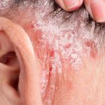 چه چیزی می‌تواند باعث ایجاد جوش یا بپورات پوستی پشت گوش شود؟