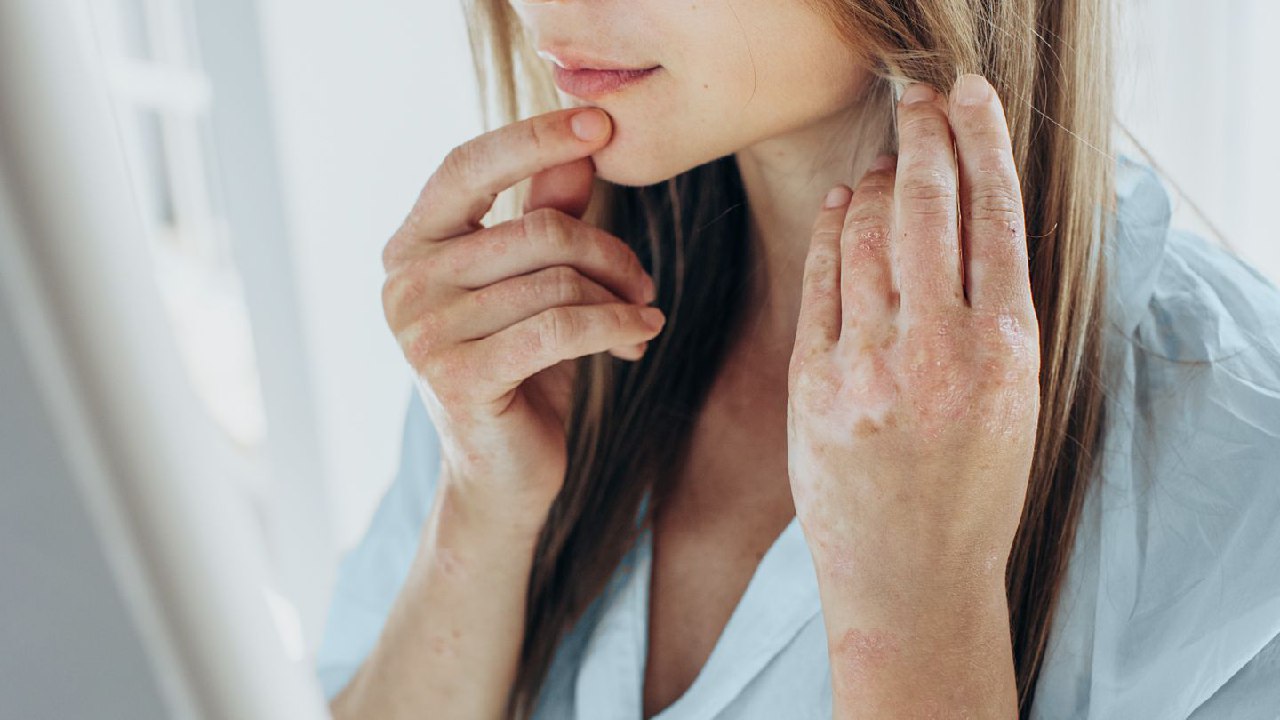 https://www.everydayhealth.com/skin-conditions/psoriasis-and-bipolar-disorder/