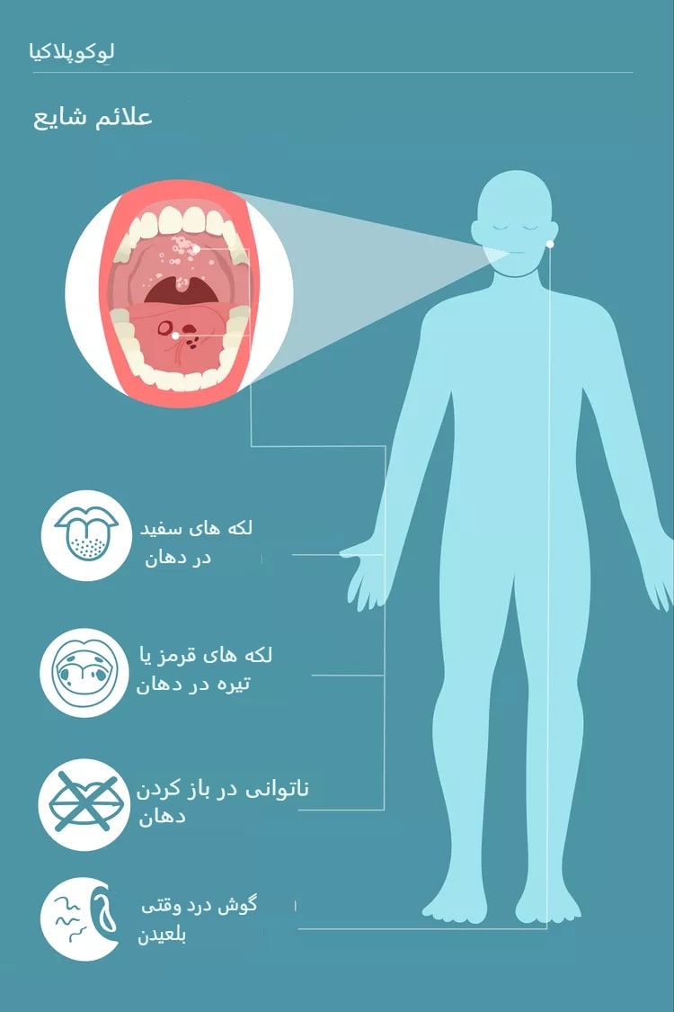 لوکوپلاکی