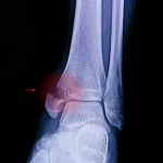 هر آنچه باید در مورد شکستگی قوزک داخلی (Medial Malleolus) بدانید