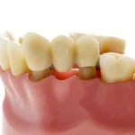 بریج دندانی چیست و آیا باید از آن استفاده کنید؟
