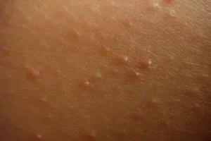 وداع با برجستگی‌های پوستی مزاحم با راهکارهای طبیعی