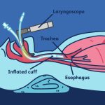 لوله‌گذاری داخل نای (Intubation) چیست و چرا انجام می‌شود؟