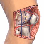 دلایل و روش‌های درمان پارگی تاندون کشکک (Patellar Tendon Tear)